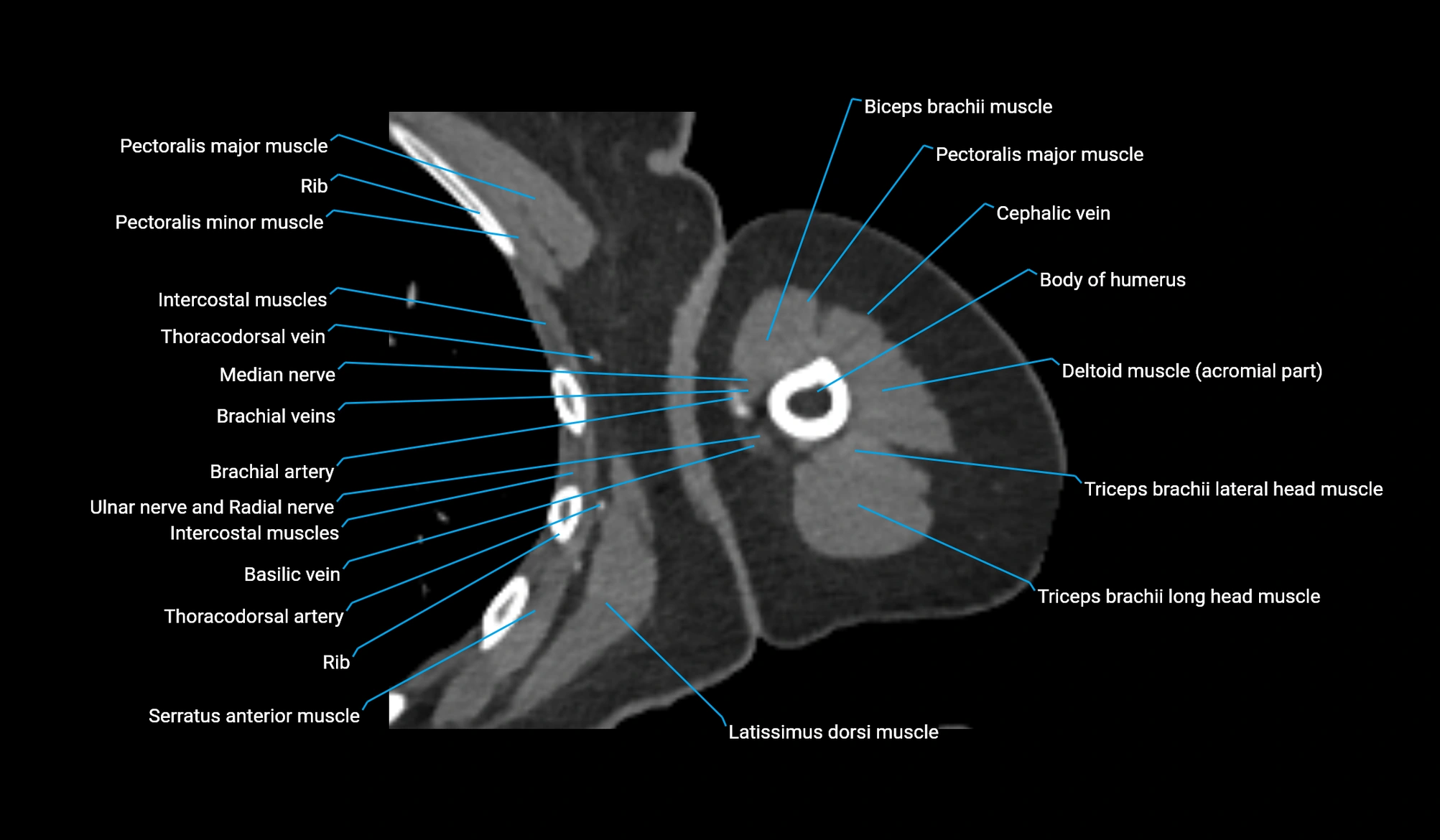 CT upper arm axial  cross sectional anatomy labelled radiology image -00180.webp